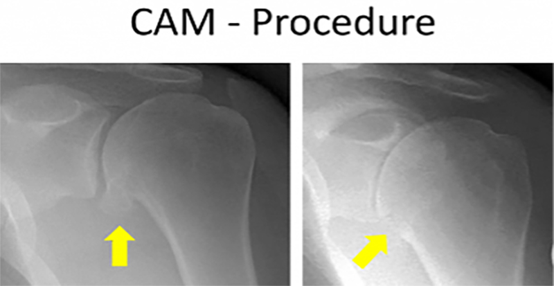 cam procedure 1