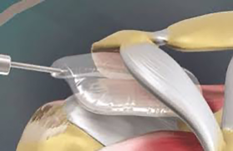 cam procedure 2