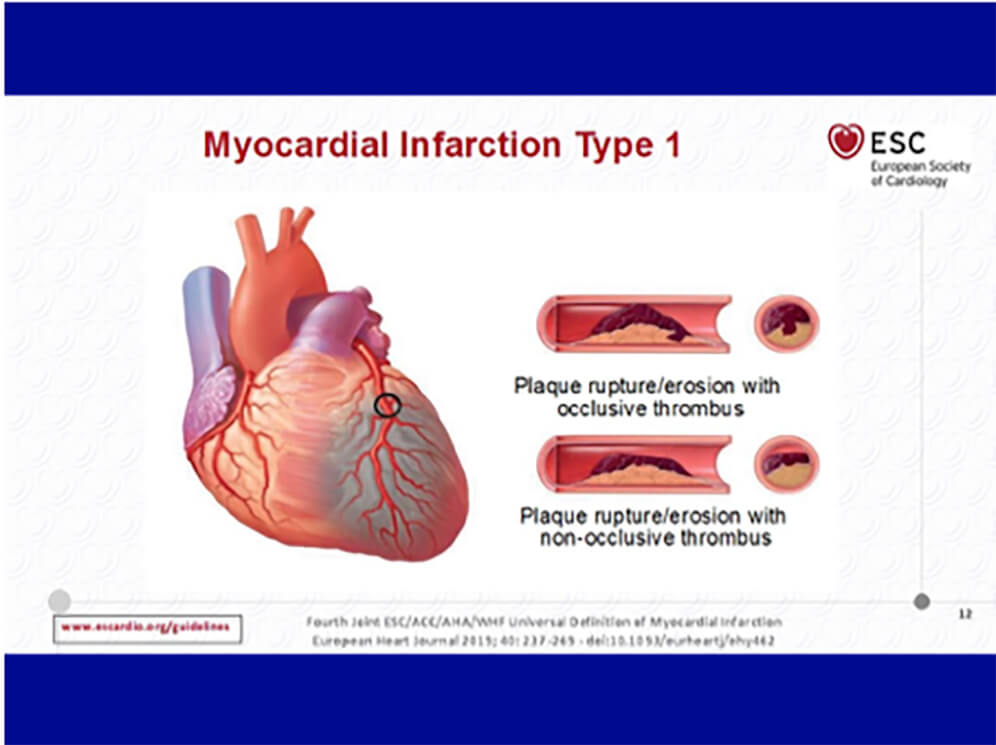 myocardial1