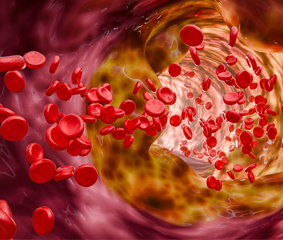 Περιφερική Αρτηριοπάθεια: Διάγνωση και σύγχρονες θεραπευτικές επιλογές