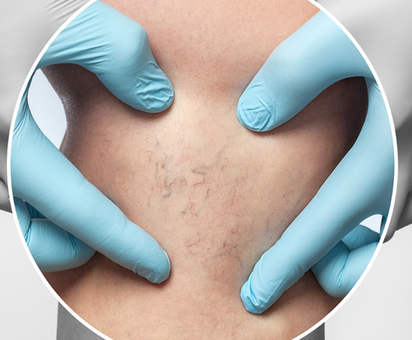 Σκληροθεραπεία: η μόνη αξιόπιστη λύση για την εξάλειψη των ευρυαγγειών